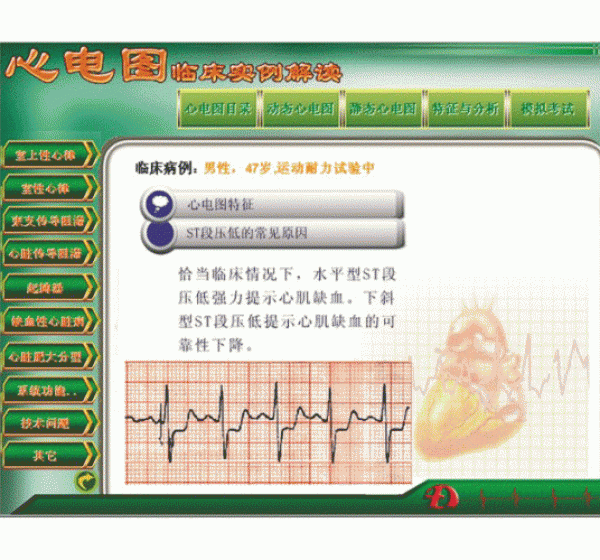 新版心電圖教學(xué)軟件心電圖臨床實例解讀