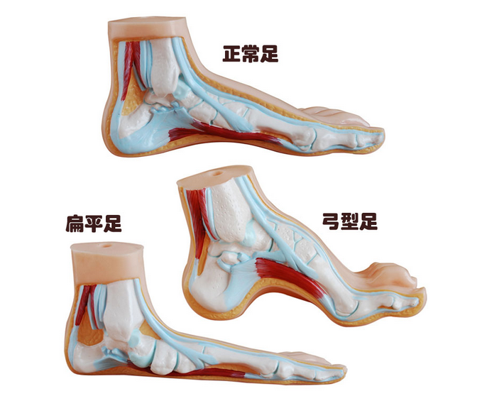 正常足、扁平足、弓型足模型